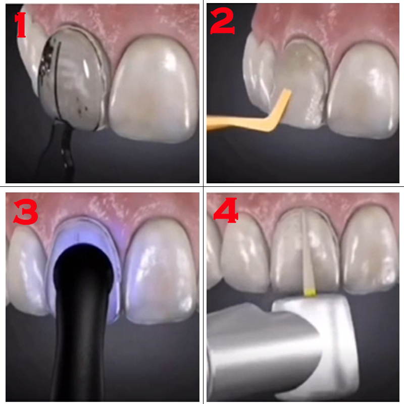 แม่พิมพ์วีเนียร์ฟันที่สามารถนึ - Teeth Whitening Moulds บทวิจารณ์และราคา