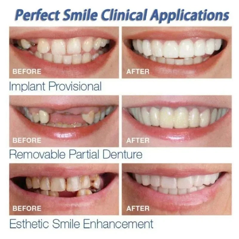 ชุดฟันปลอมแบบสวม ปรับได้ ฟันปล - Teeth Whitening Kit บทวิจารณ์และราคา